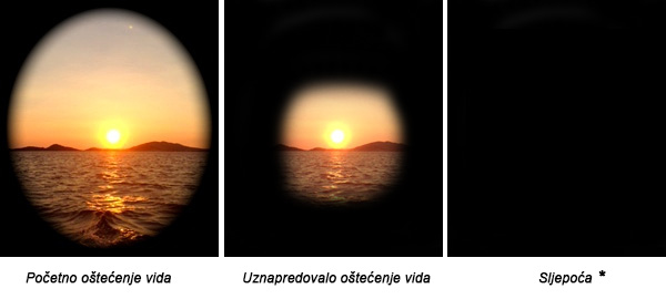 početno / uznapredovalo oštećenje vida, slijepoća